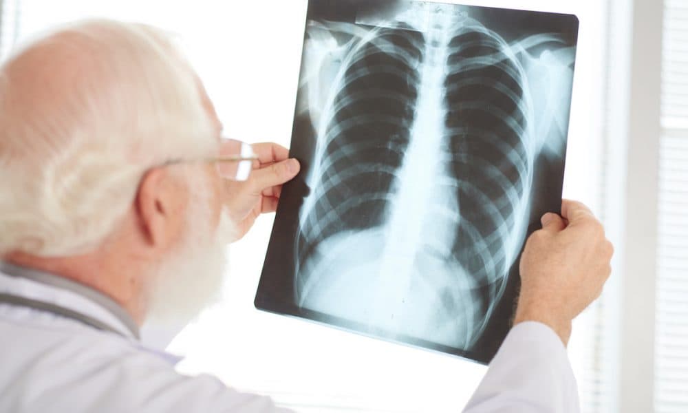 £10m research collaboration to explore earlier lung cancer diagnosis