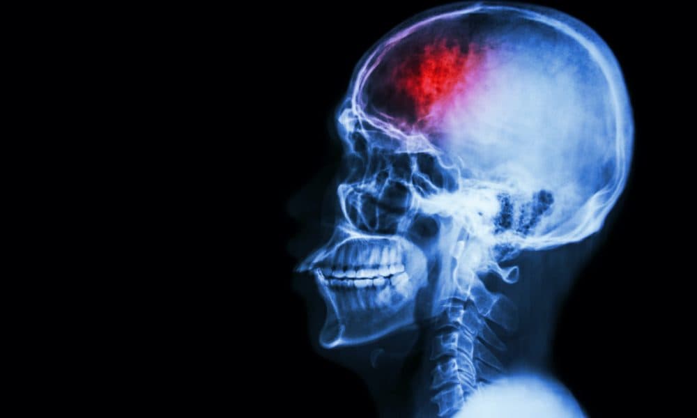 Wearable laser device monitors brain blood flow to gauge stroke risk