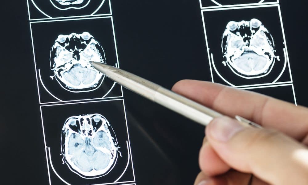 Re:Cognition Health CEO on using DTI imaging to diagnose CTE