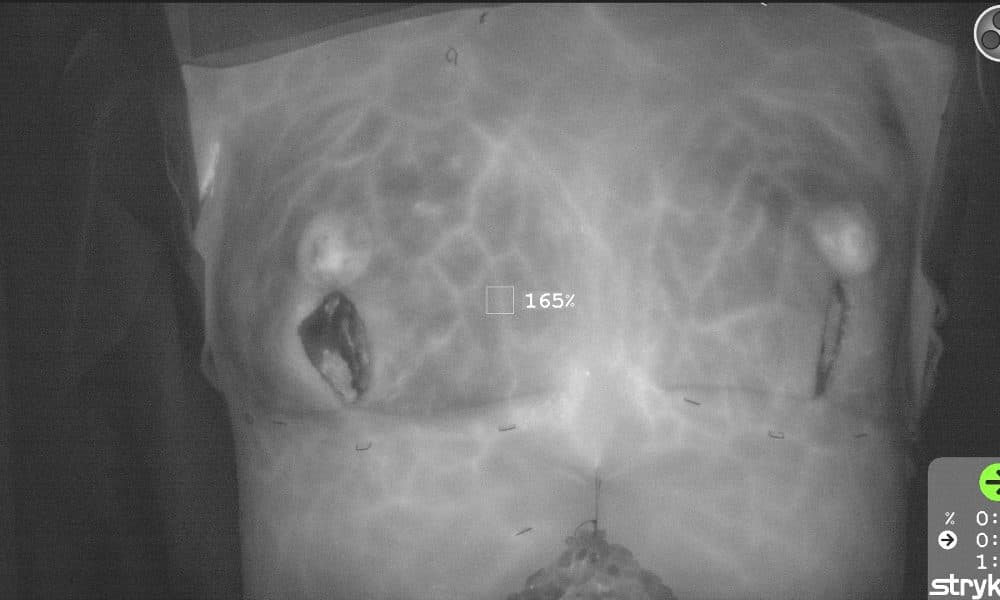 Breast cancer surgery technique reduces side effects
