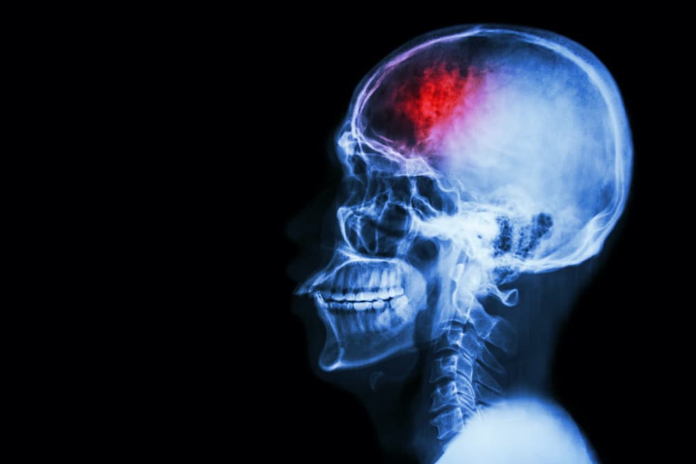Stroke rehab tech firm BrainQ has received a major funding boost.