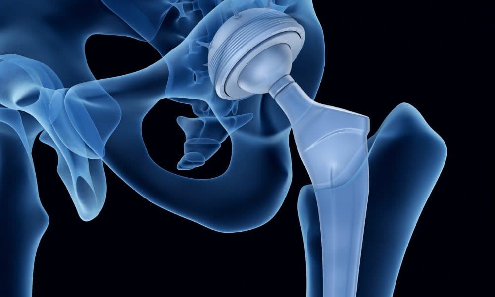 Developing bioactive coatings for better orthopaedic implants