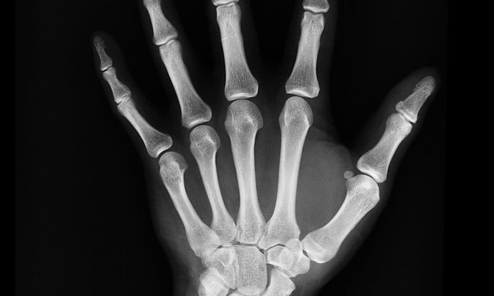 Artificial intelligence accurately detects fractures on X-rays
