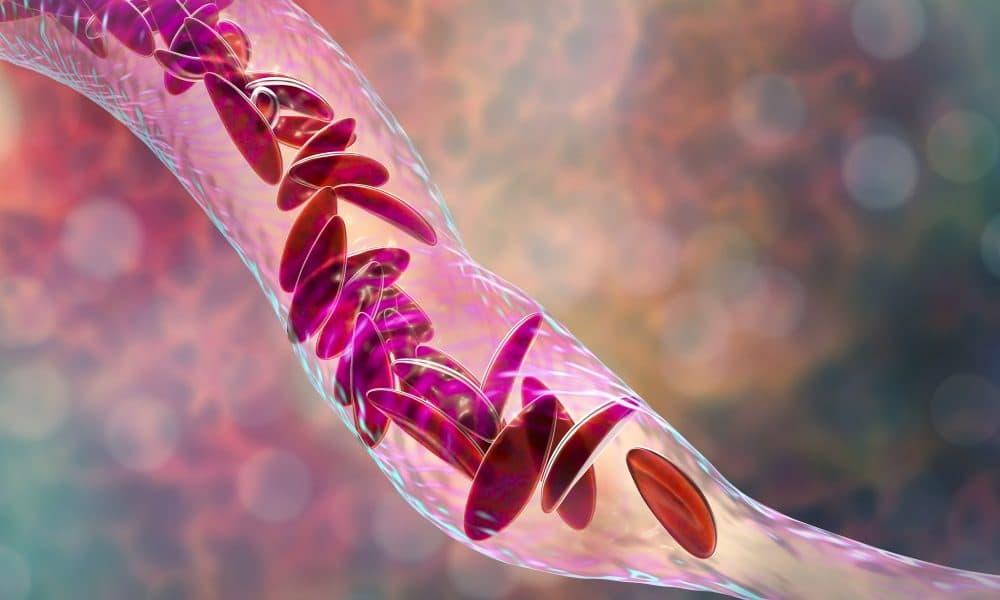 York researchers awarded £2.3m for sickle cell anaemia research