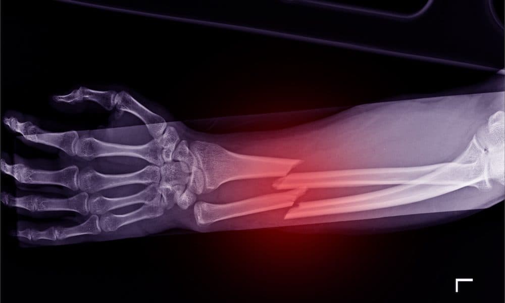 3D simulations may help with healing of broken bones