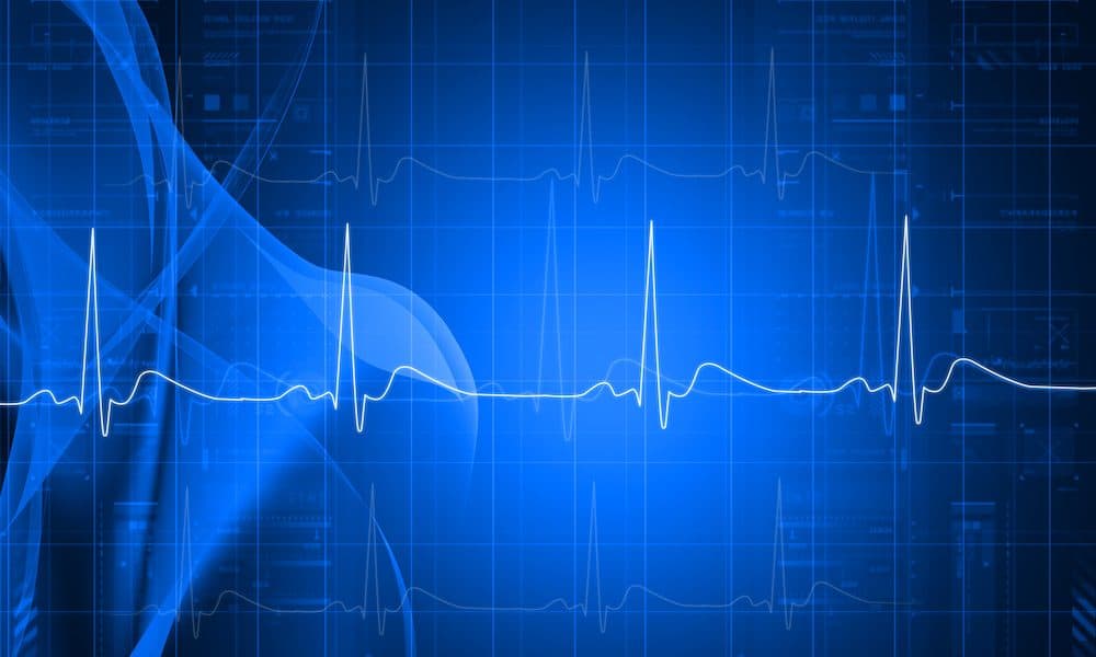 AI-enabled ECGs may identify greater stroke risk