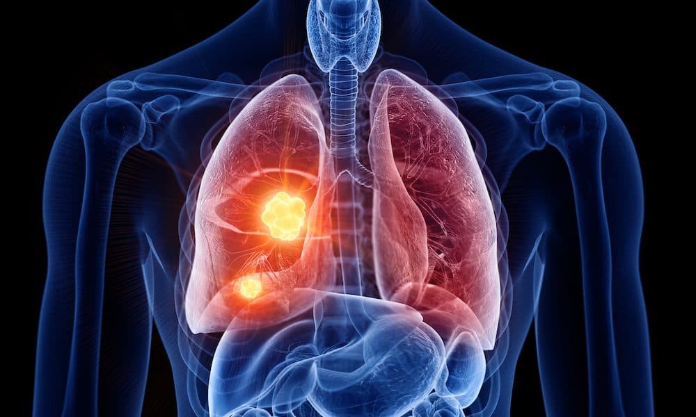Imaging tech may detect lung cancer earlier, study finds