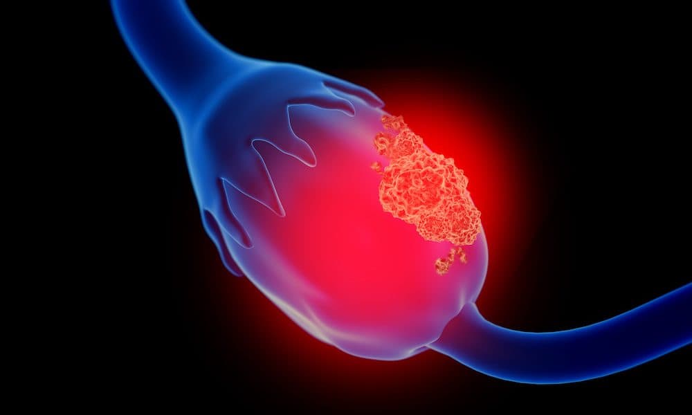 Nanosensor platform could advance detection of ovarian cancer