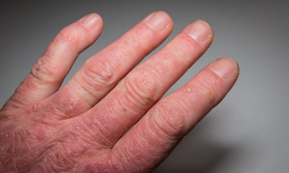 AI tool could cut diagnostic time for psoriatic arthritis patients