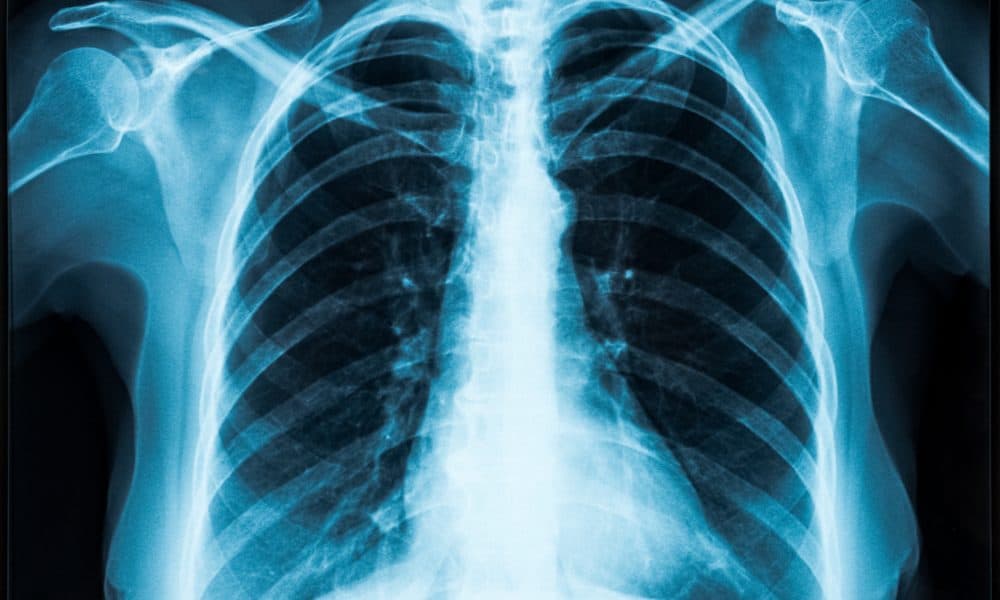 AI predicts heart disease risk from single X-ray