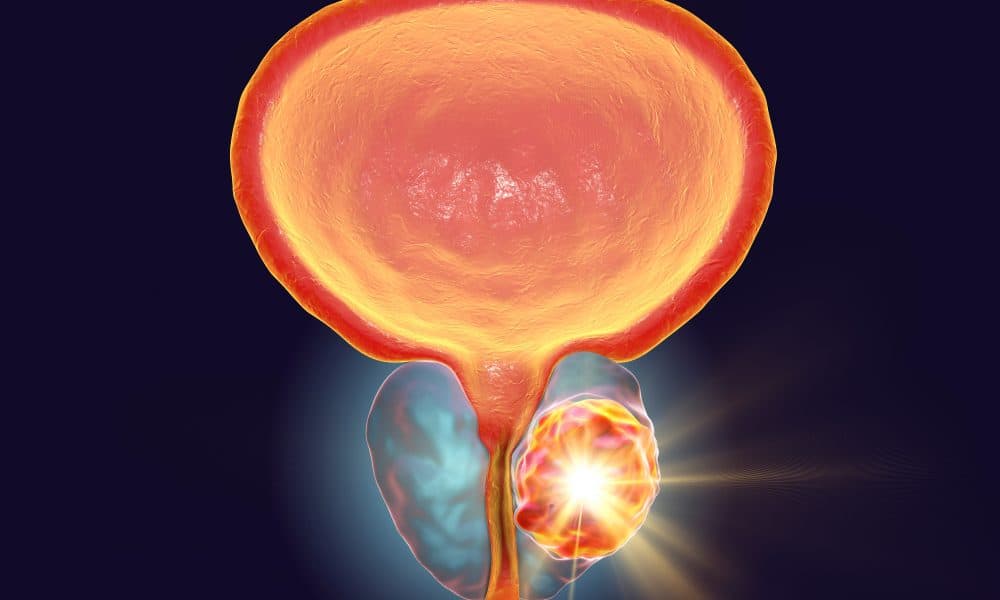 Emerging AI could replace traditional MRI for prostate cancer