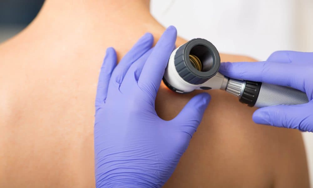 NHS expands high-res skin imaging to accelerate diagnoses and treatment of skin cancer