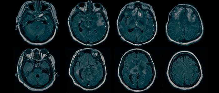 Low-Res_Claassen_MRI-collage_warm+moody-filter Research finds source of hidden consciousness in ‘comatose’ brain injury patients