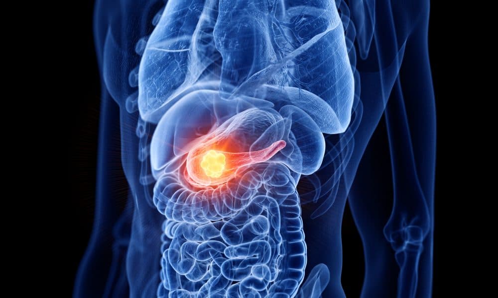 Research links Type 2 diabetes to pancreatic cancer