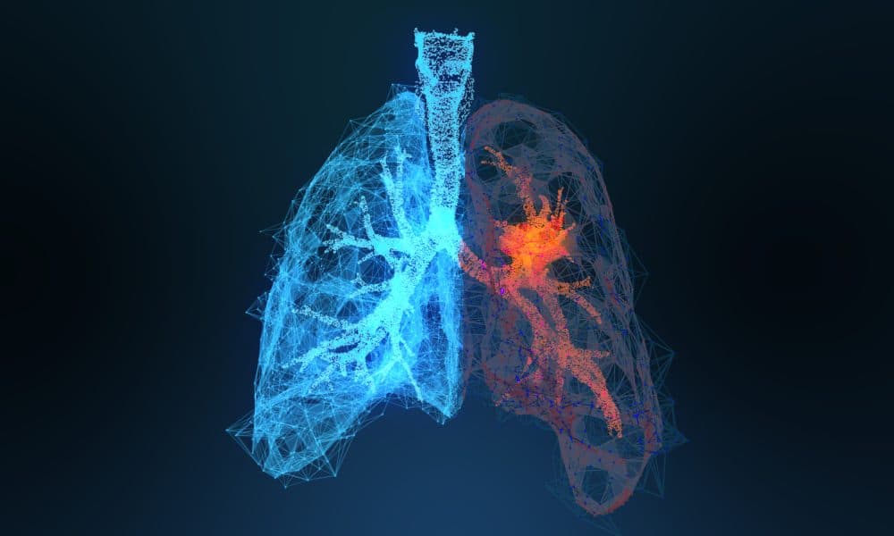 AI could predict risk of lung cancer at an earlier stage, study finds