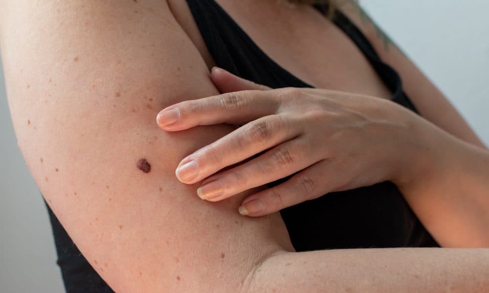 AdobeStock_512723879 AI-powered device identifies 5% of all UK melanoma cases