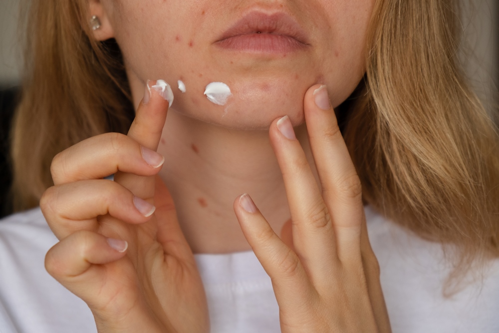 unrecognizable-woman-applies-makeup-cream-serum-cure-acne-face-close-up-acne-womans Exeter biotech partners with L’Oréal on ageing research