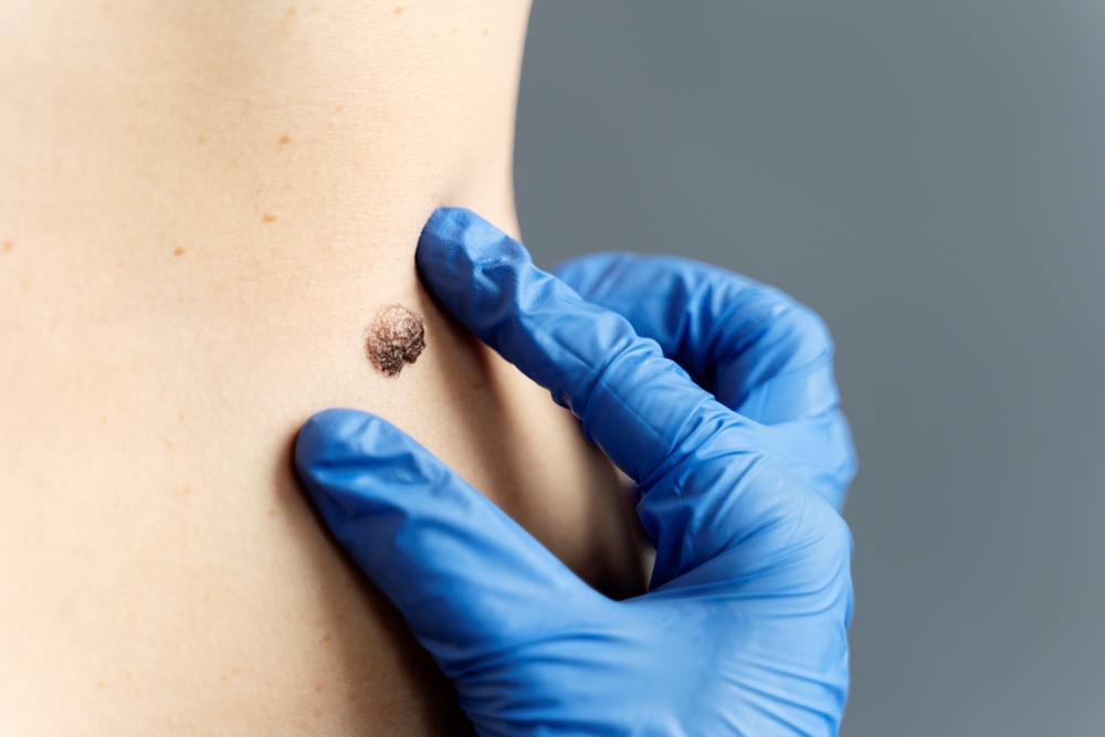 close-up-hand-with-glove-measuring-mole AI and mole mapping: Transforming the future of skin cancer detection